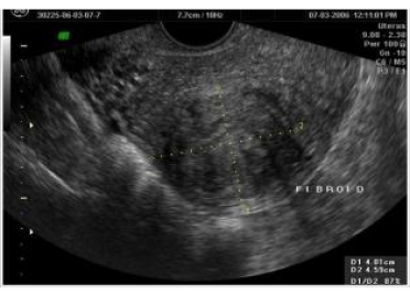 USG image of fibroid (Fibromyoma)