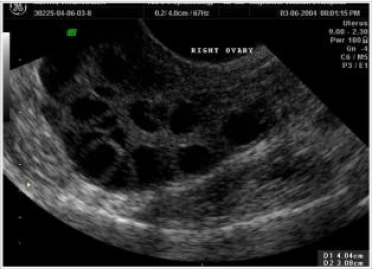 Doppler study of follicle