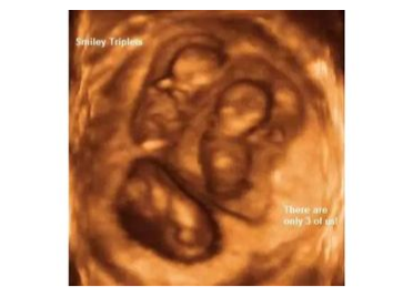 USG image of 3D triplet babies