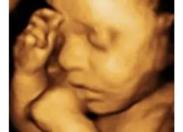 USG image of 3D baby face