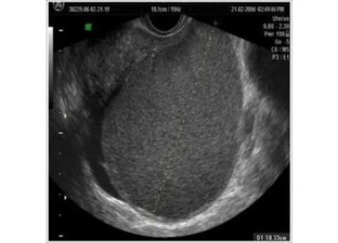 USG image of Endometrioma