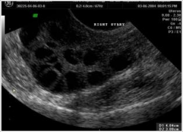 USG image of Polycystic Ovaries