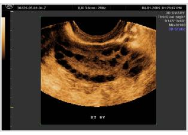USG image of Polycystic Ovary