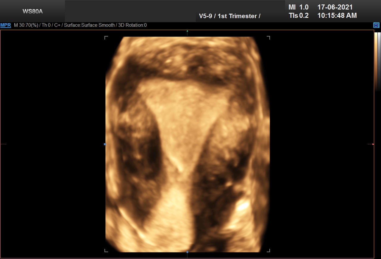 ENDOMETRIUM_0006_TRIPL