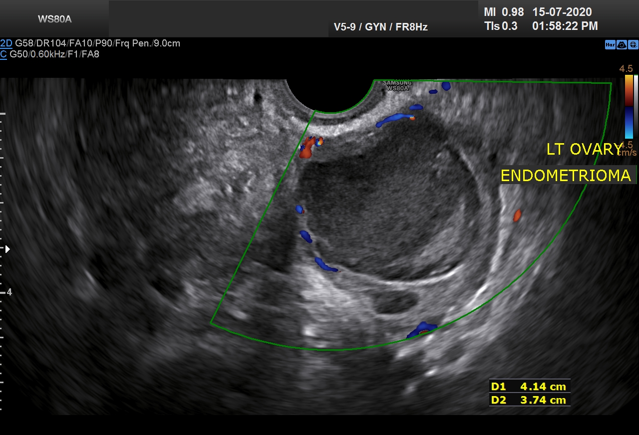 FIBROID AND ENDOMETRIOMA_0002