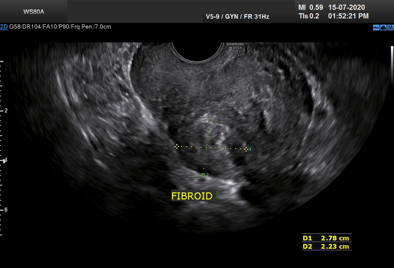 FIBROID AND ENDOMETRIOMA_0003
