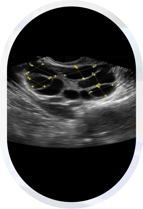 Follicular monitoring