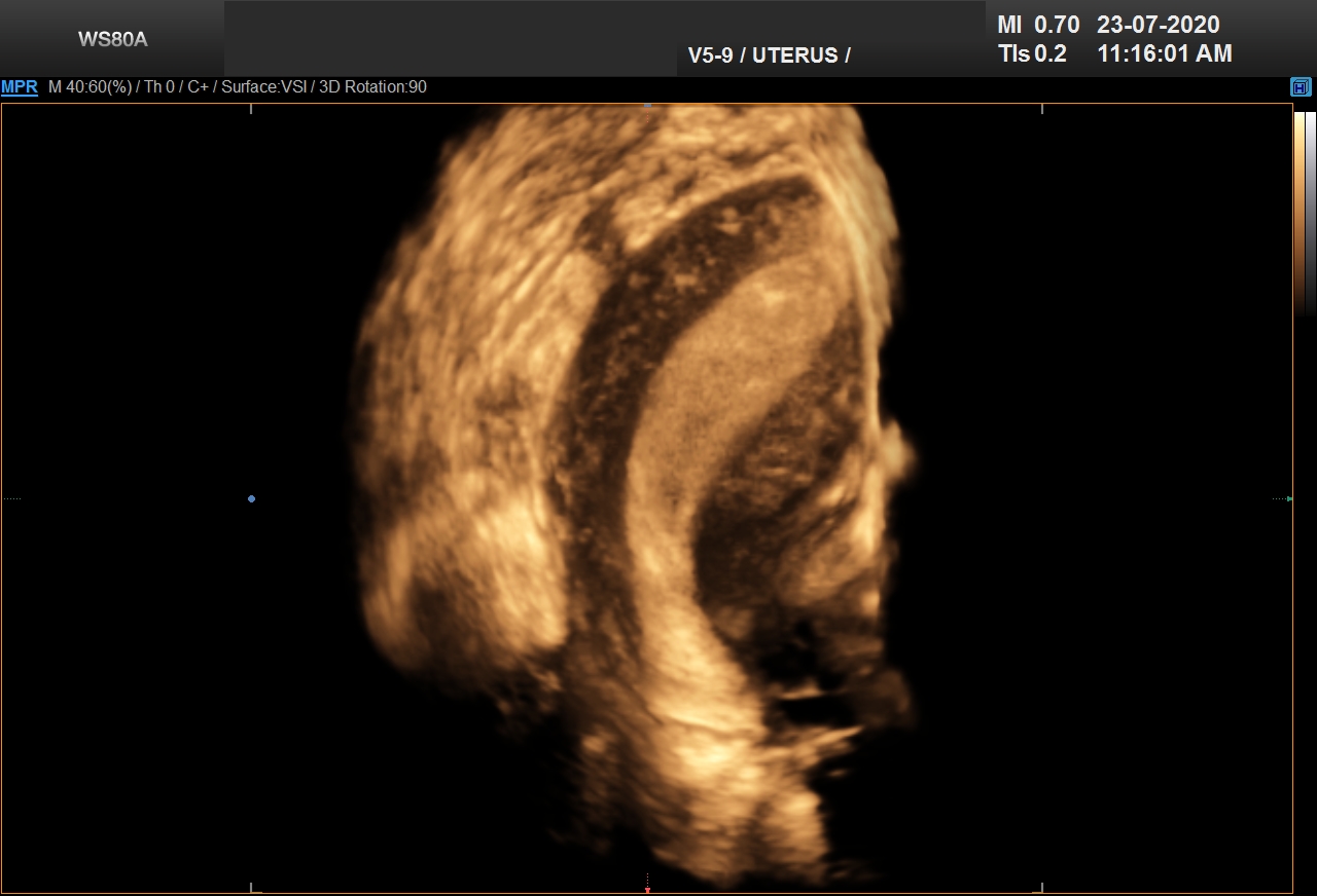 UNICORNUATE UTERUS_0002