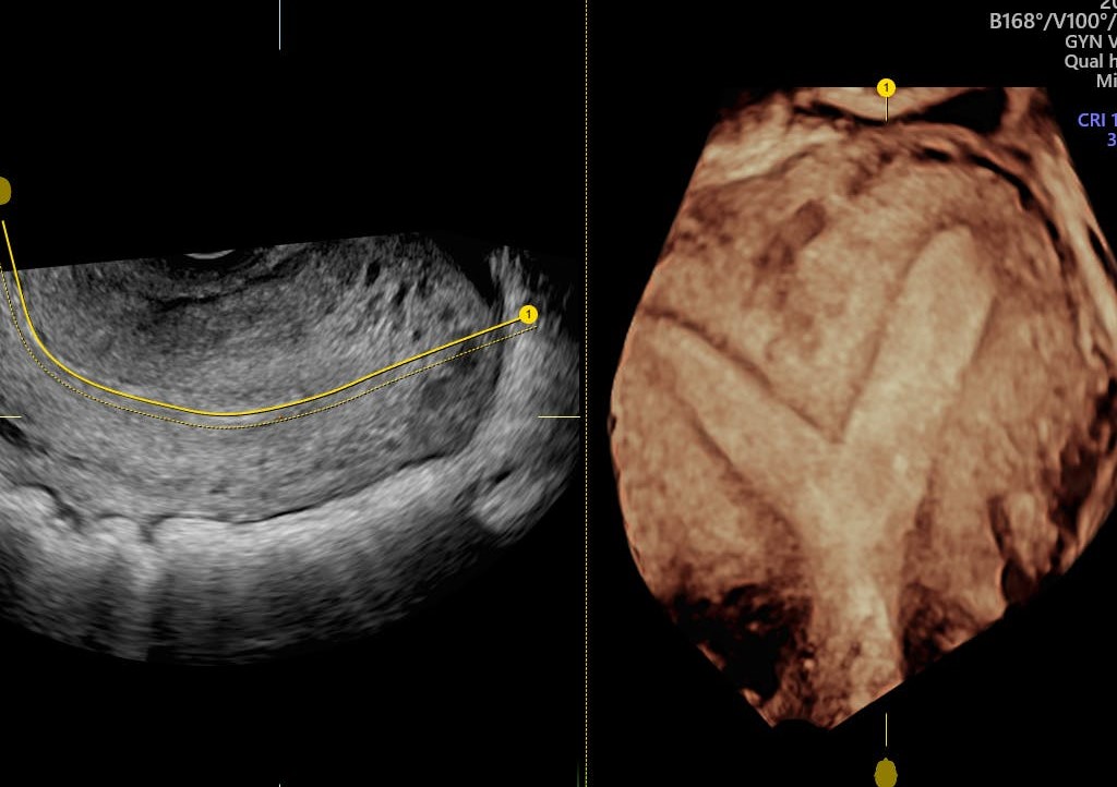 septate uterus