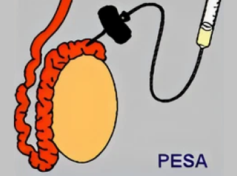 PESA