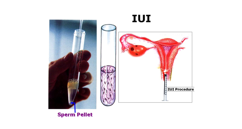 IUI services