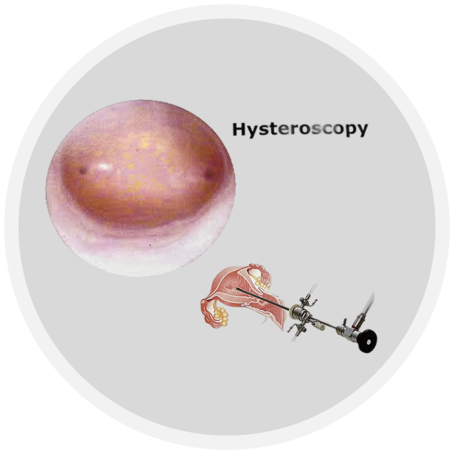 Hysteroscopy