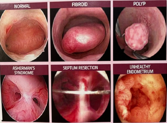 Hysteroscopy-surgery