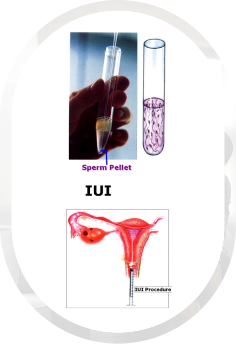IUI Treatment