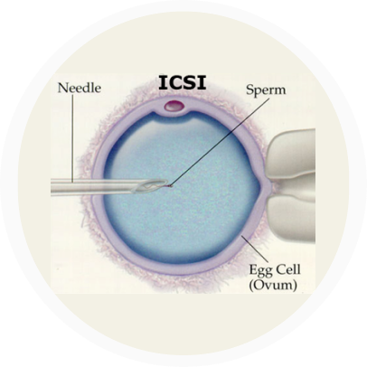 Indications for ICSI