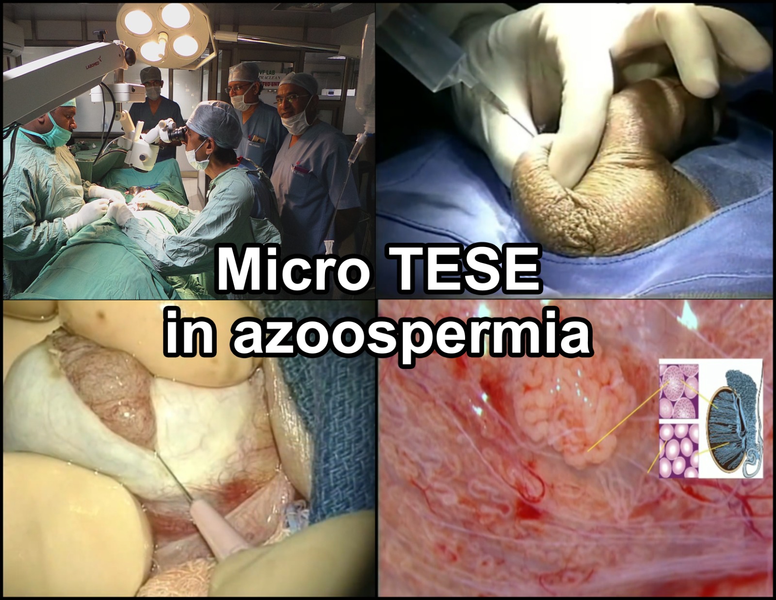 Microdissection TESE
