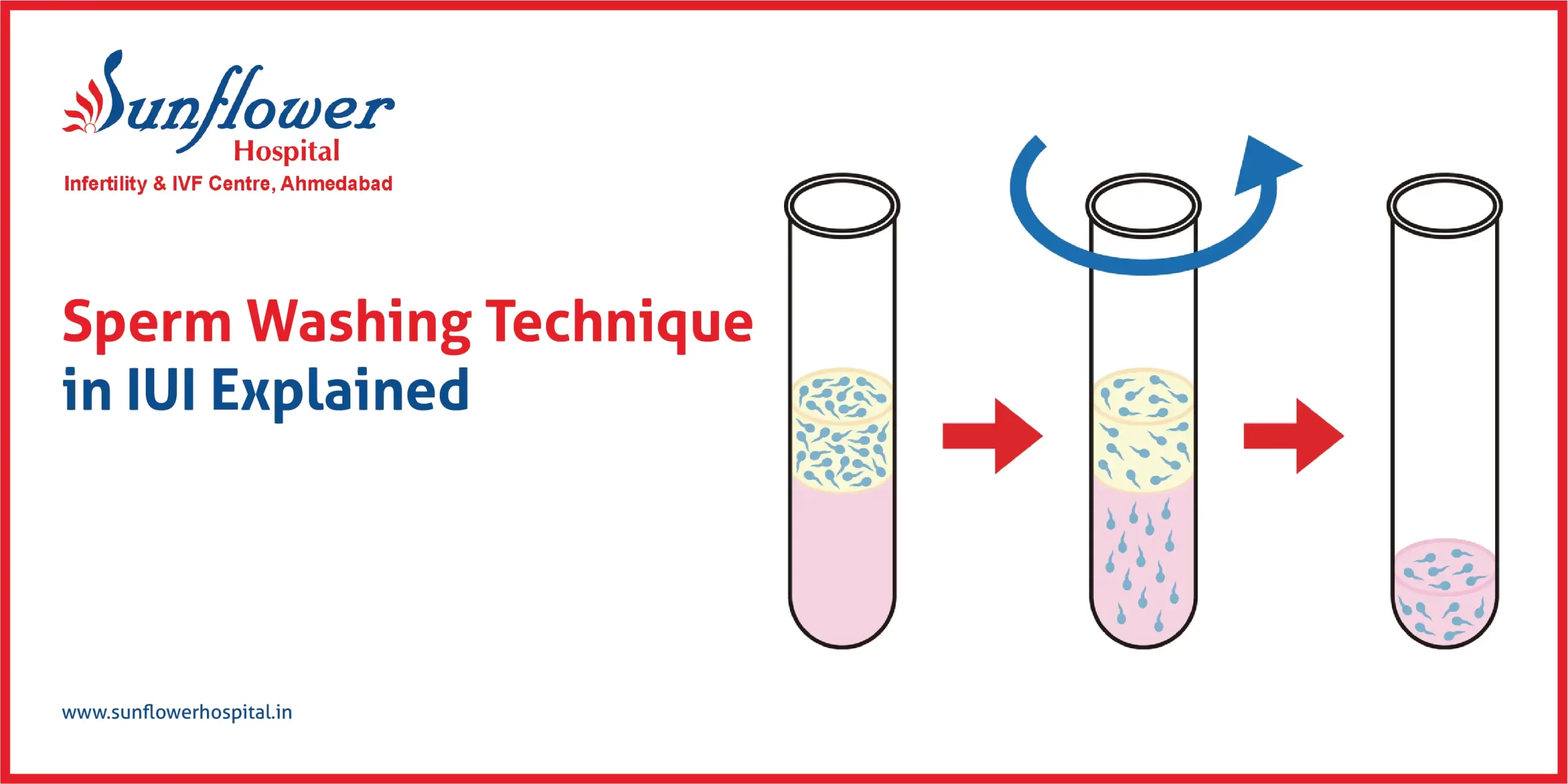 Sperm Washing Technique
