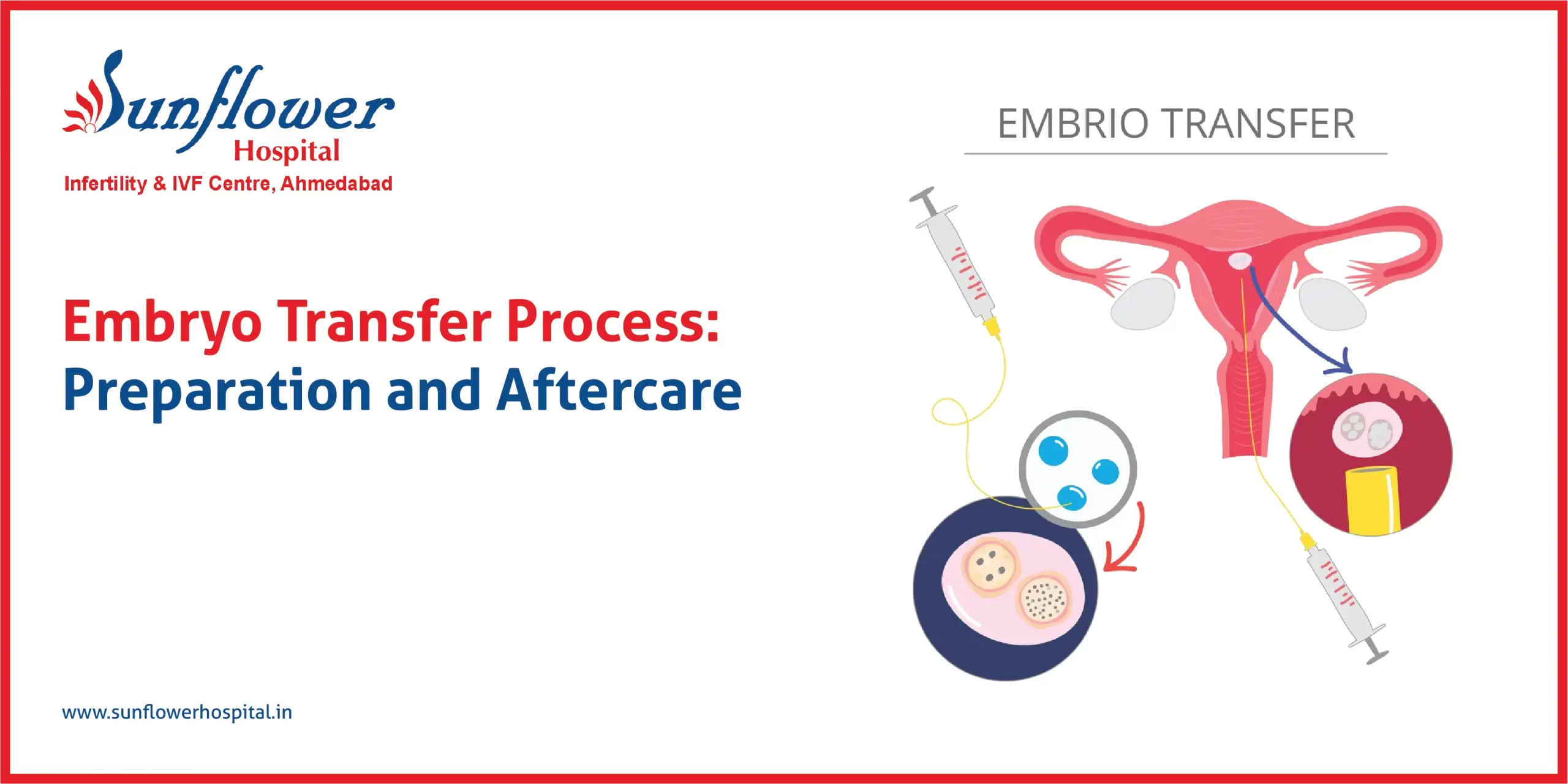 Embryo Transfer Process: Preparation and Aftercare Explained