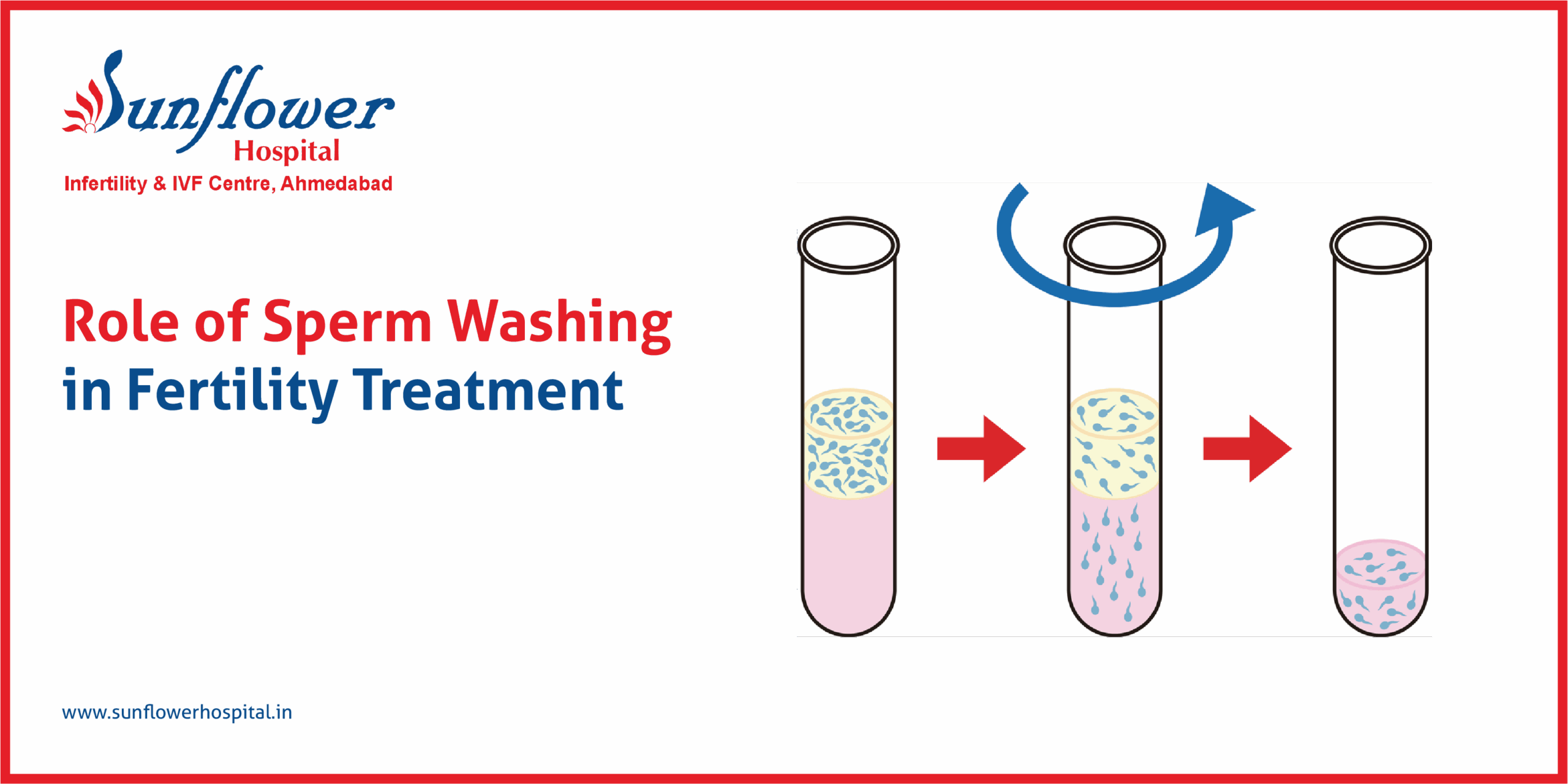 Role of Sperm Washing in Fertility Treatment